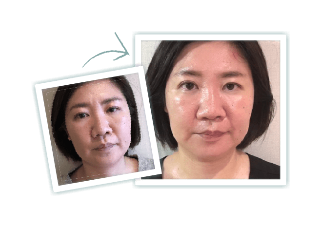 施術前と施術後の顔のむくみの比較