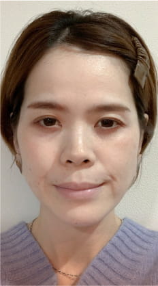 施術前の女性の顔